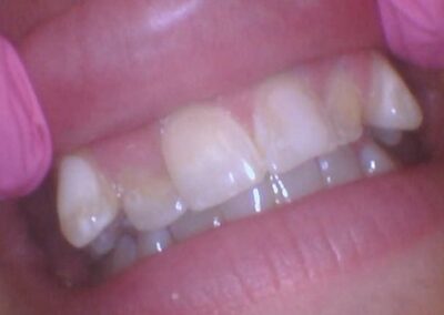 Close-up of the upper front teeth with crowding and slight misalignment, held open by gloved fingers in pink gloves.