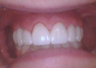 Close-up of upper front teeth with a small gap between the central incisors and visible gums.